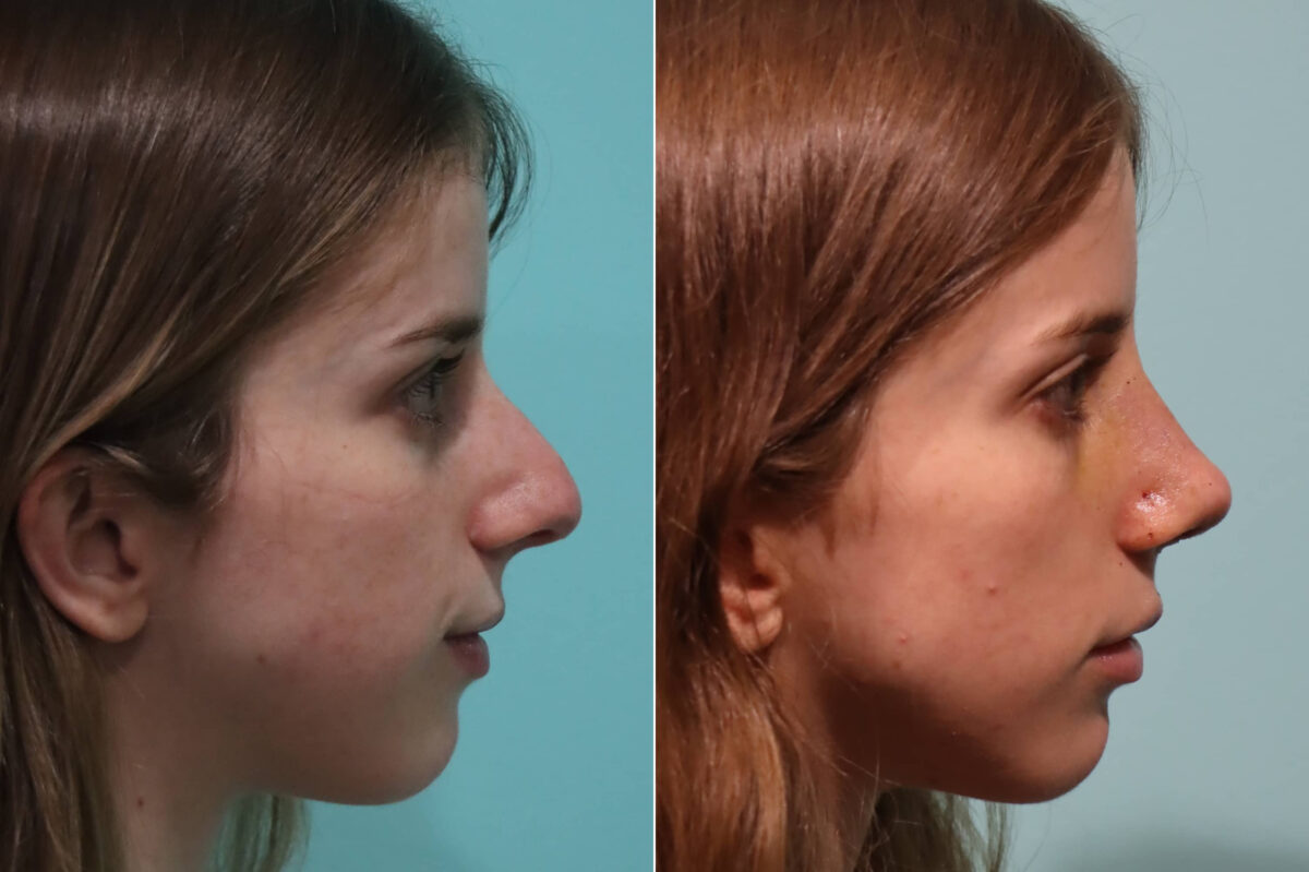 Before and after Rhinoplasty by Dr. Shervin Naderi, Patient 22409