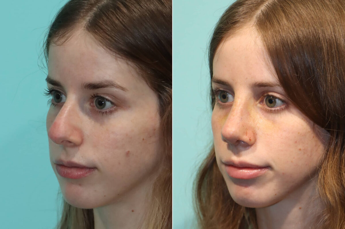 Before and after Rhinoplasty by Dr. Shervin Naderi, Patient 22409