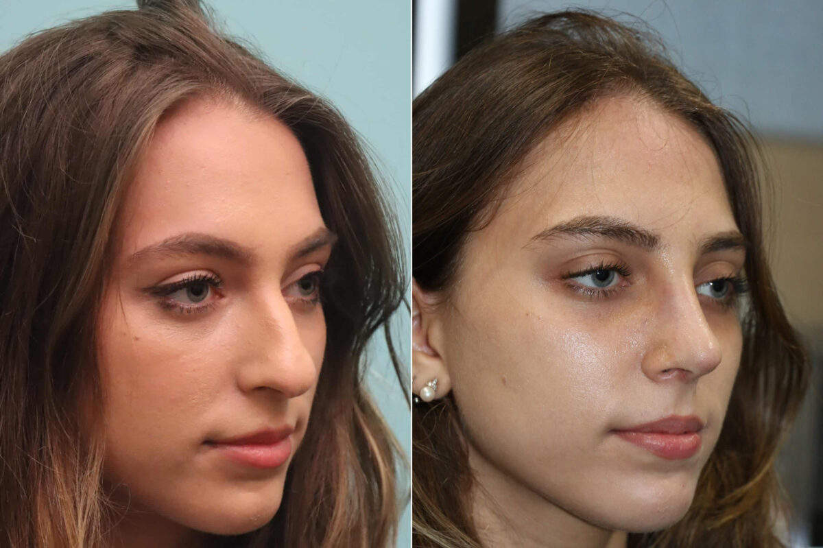 Before and after Rhinoplasty by Dr. Shervin Naderi, Patient 22470
