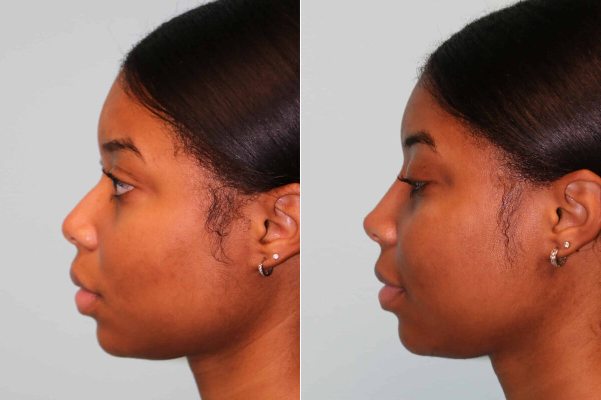 Before and after Non-Surgical Rhinoplasty by Dr. Shervin Naderi, Patient 22821