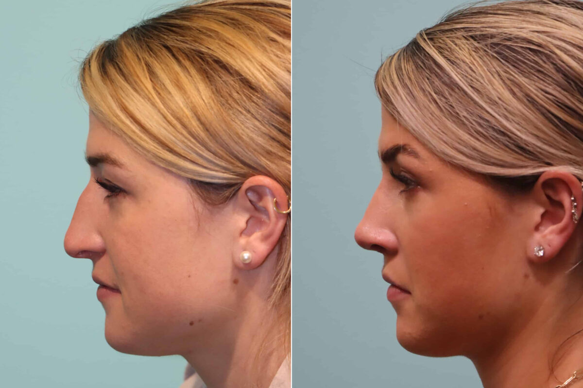 Before and after Rhinoplasty by Dr. Shervin Naderi, Patient 22837