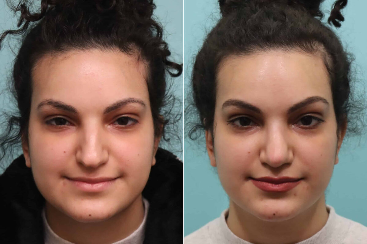Before and after Rhinoplasty by Dr. Shervin Naderi, Patient 22857