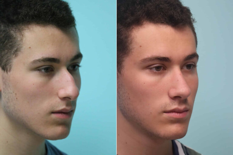Before and after rhinoplasty by Dr. Shervin Naderi: masculine and natural