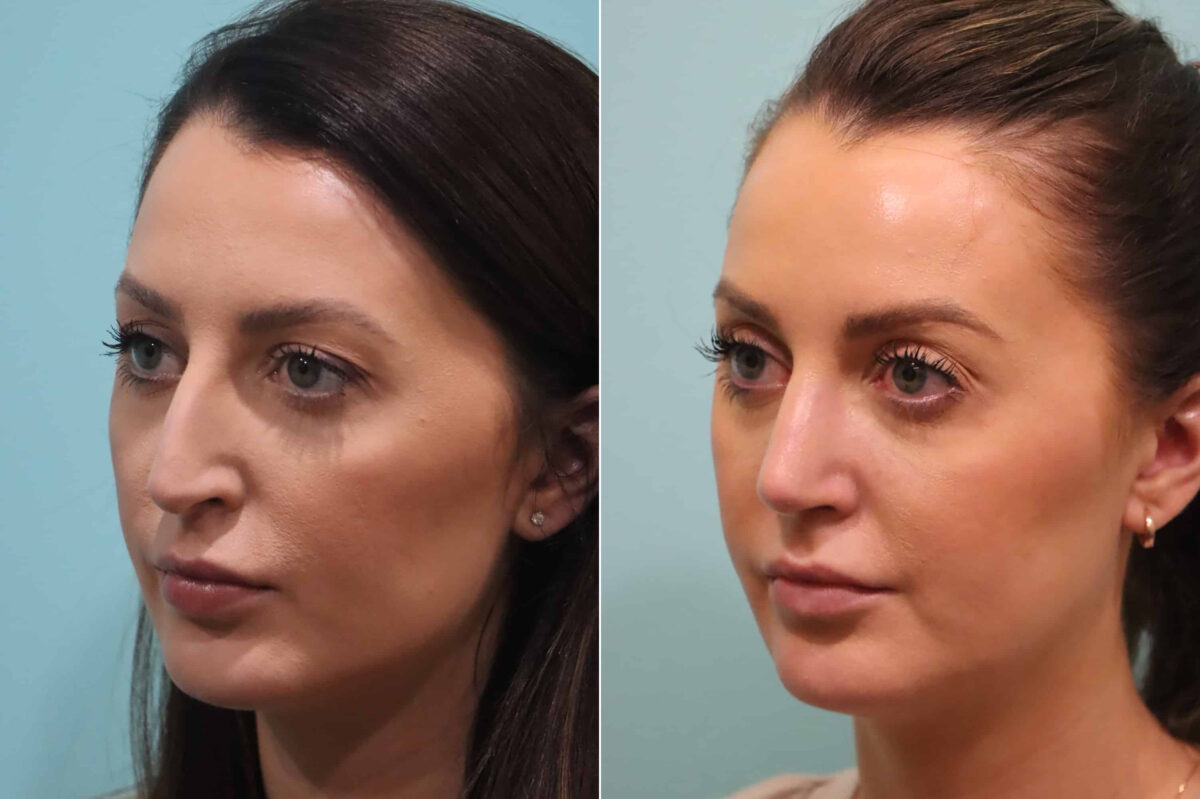 Before and after Rhinoplasty by Dr. Shervin Naderi, Patient 22985
