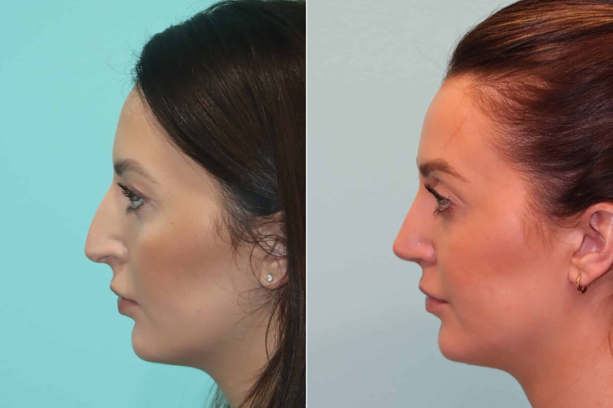 Before and after Rhinoplasty by Dr. Shervin Naderi, Patient 22985