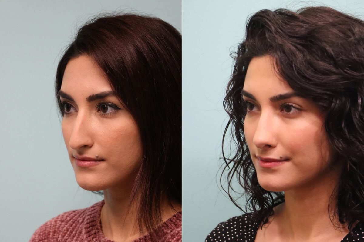 Before and after Rhinoplasty by Dr. Shervin Naderi, Patient 23959