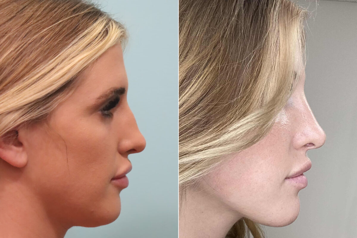 Before and after Rhinoplasty by Dr. Shervin Naderi, Patient 24153