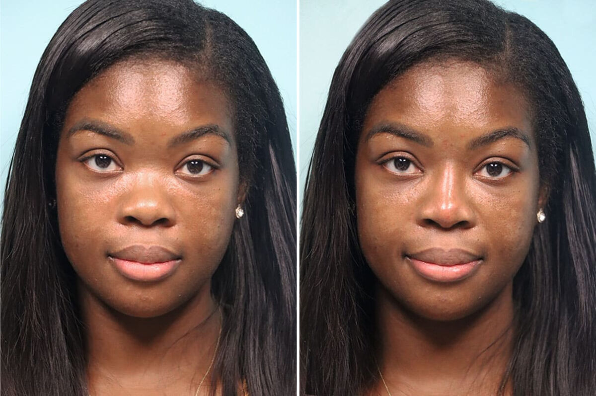 Before and after Non-Surgical Rhinoplasty by Dr. Shervin Naderi, Patient 24821