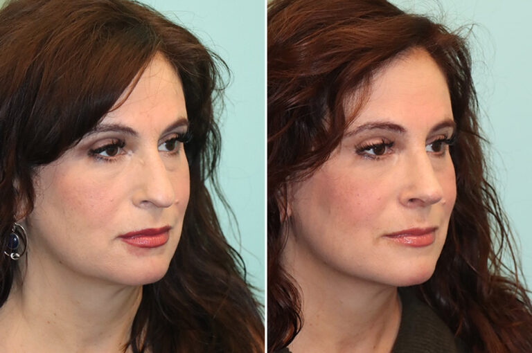 Before and after rhinoplasty by Dr. Shervin Naderi: a more youthful, refreshed look