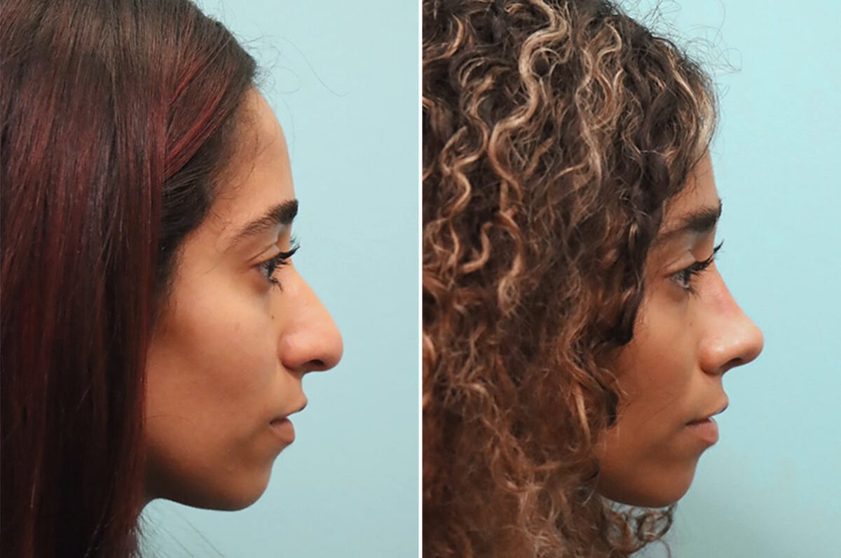 Before and after Rhinoplasty by Dr. Shervin Naderi, Patient 24851