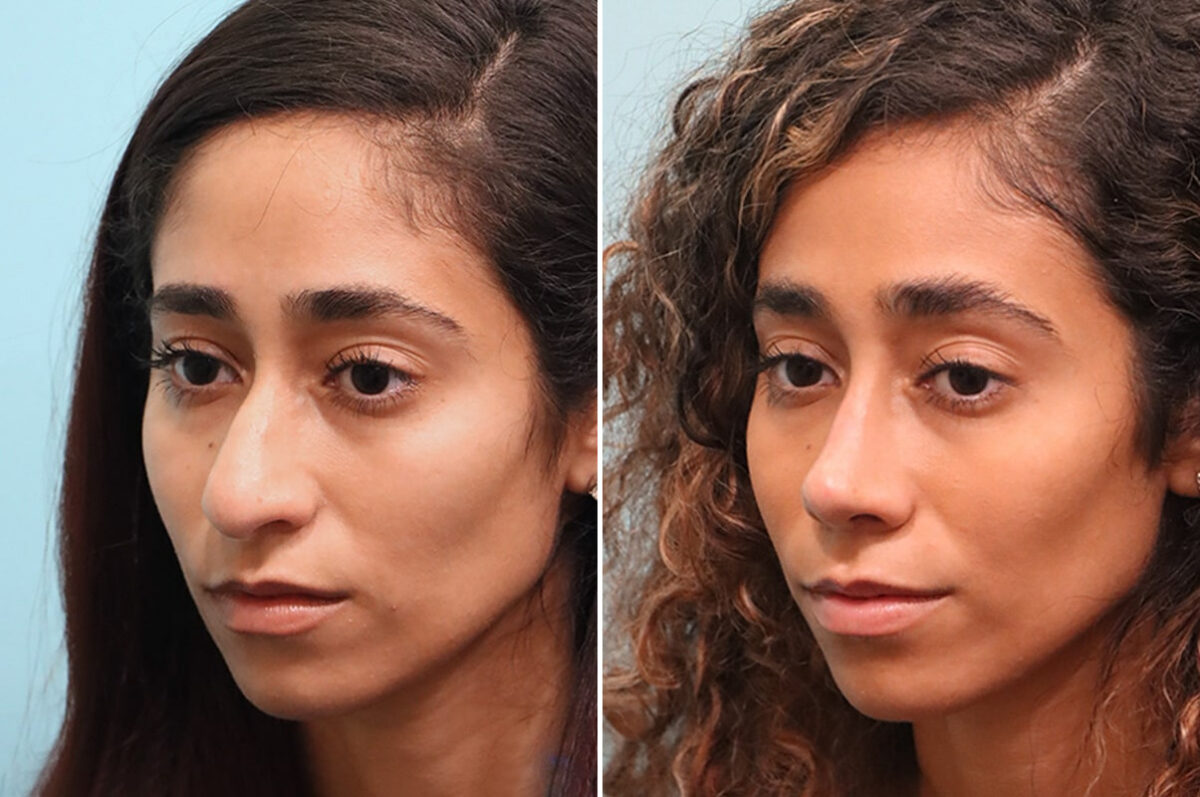 Before and after Rhinoplasty by Dr. Shervin Naderi, Patient 24851