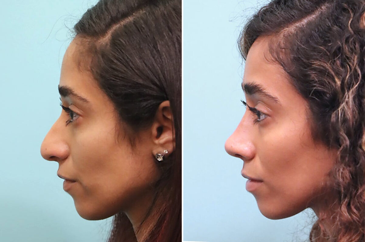Before and after Rhinoplasty by Dr. Shervin Naderi, Patient 24851