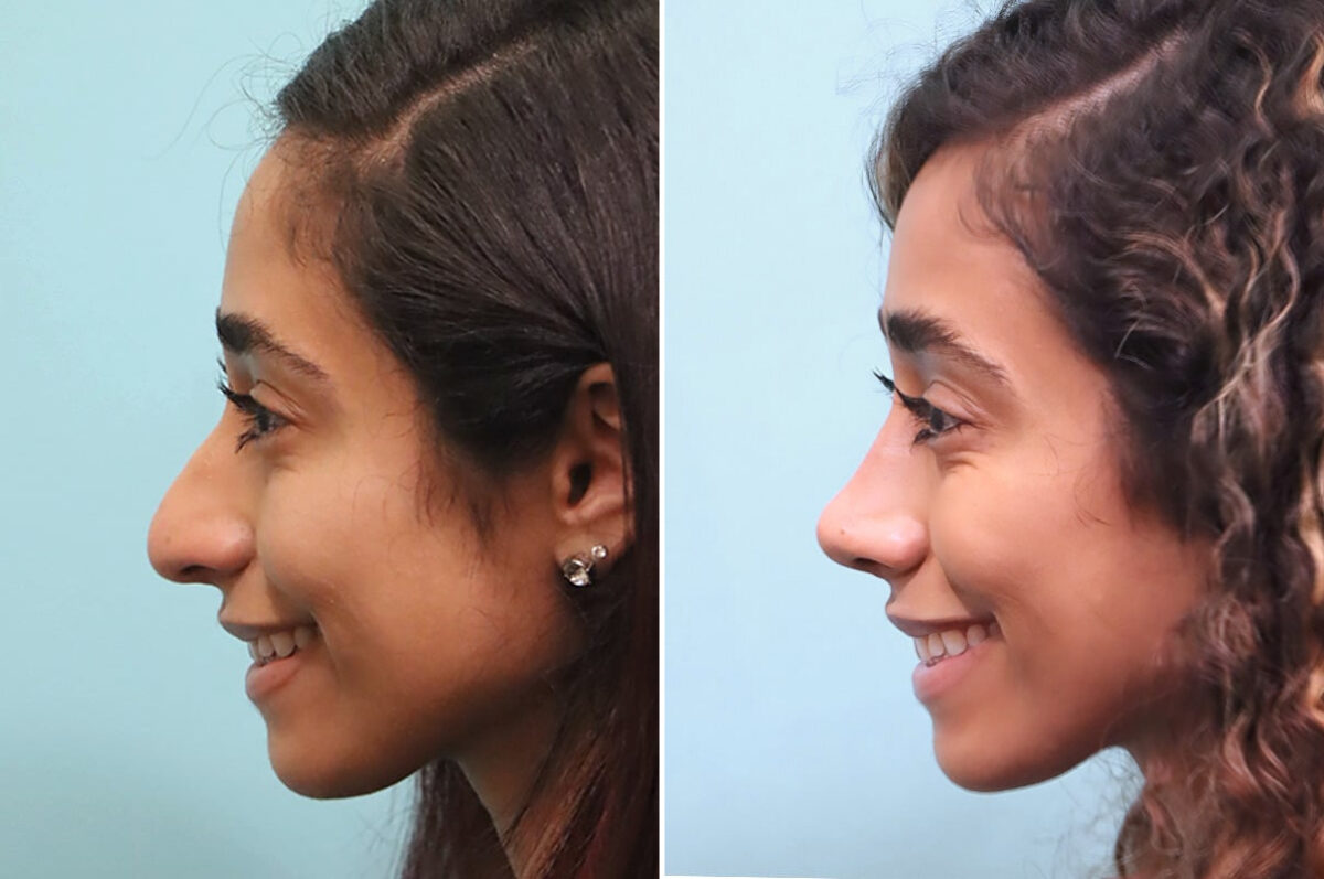 Before and after Rhinoplasty by Dr. Shervin Naderi, Patient 24851