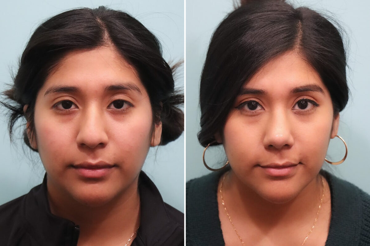 Before and after Rhinoplasty by Dr. Shervin Naderi, Patient 25035