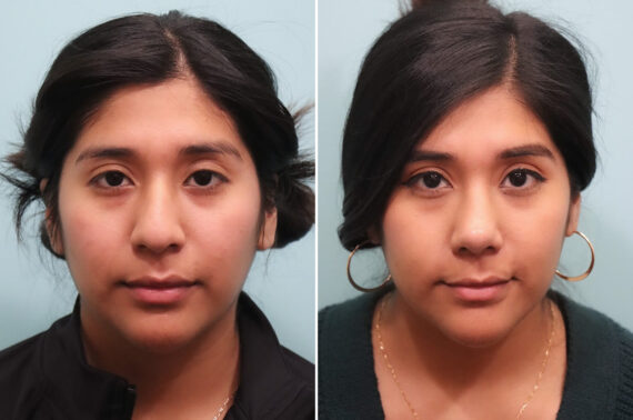 Before and after Rhinoplasty by Dr. Shervin Naderi, Patient 25035