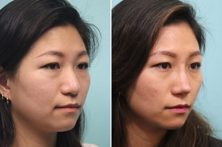 Before and after rhinoplasty by Dr. Shervin Naderi: thick skin and a refined tip