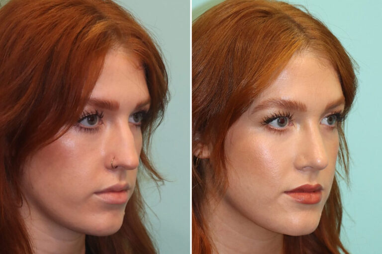 Before and after rhinoplasty by Dr. Shervin Naderi: profile and dorsal hump