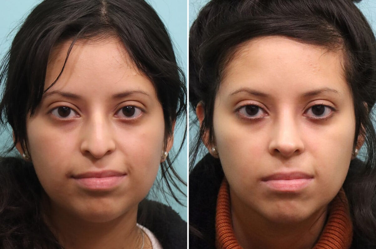 Before and after Rhinoplasty by Dr. Shervin Naderi, Patient 25212