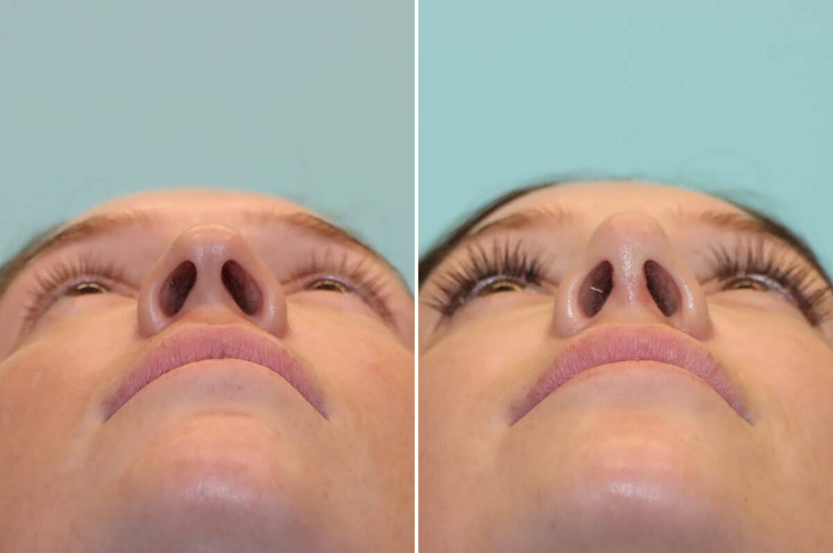 Before and after Rhinoplasty by Dr. Shervin Naderi, Patient 25244