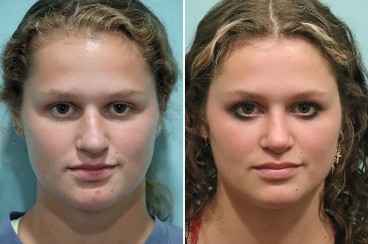 Before and after Rhinoplasty by Dr. Shervin Naderi, Patient 25553