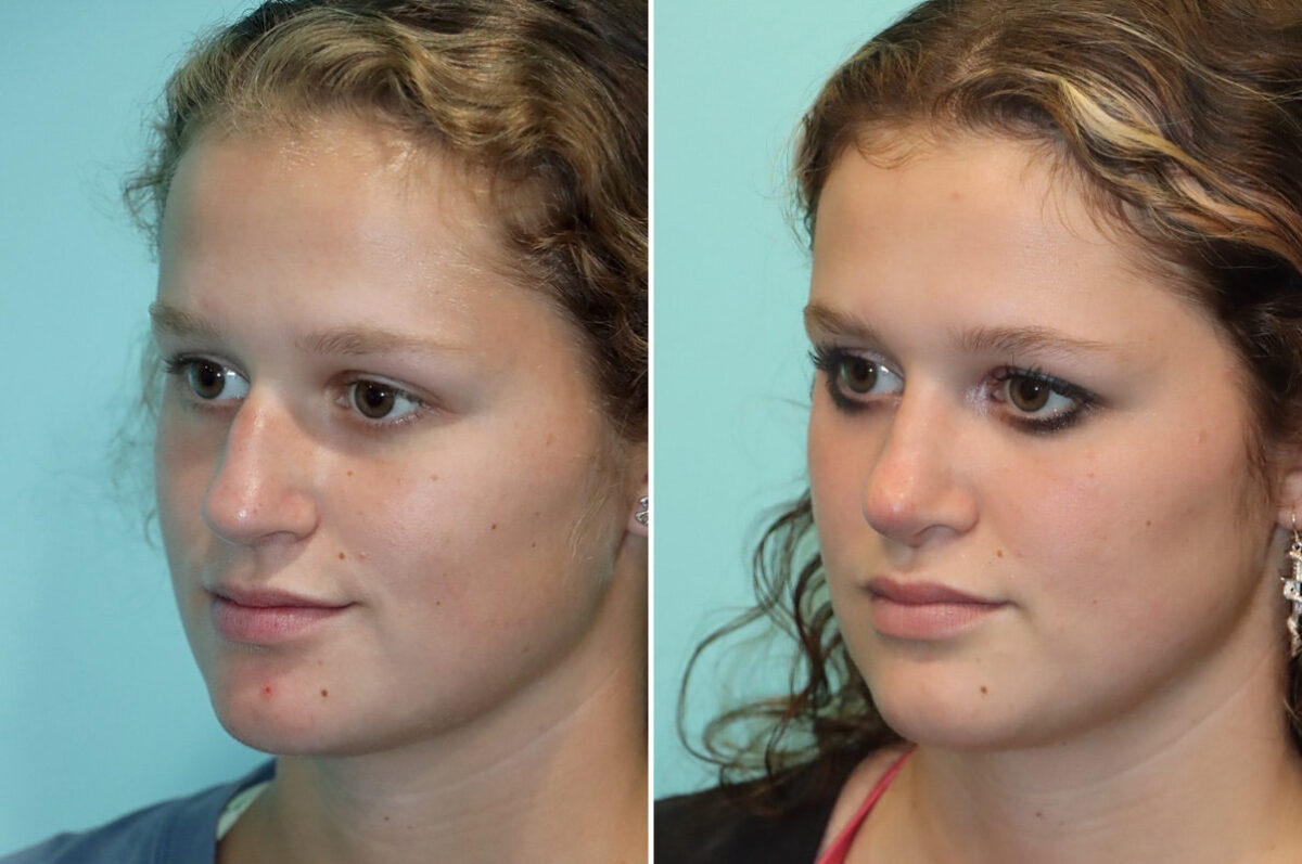 Before and after Rhinoplasty by Dr. Shervin Naderi, Patient 25553
