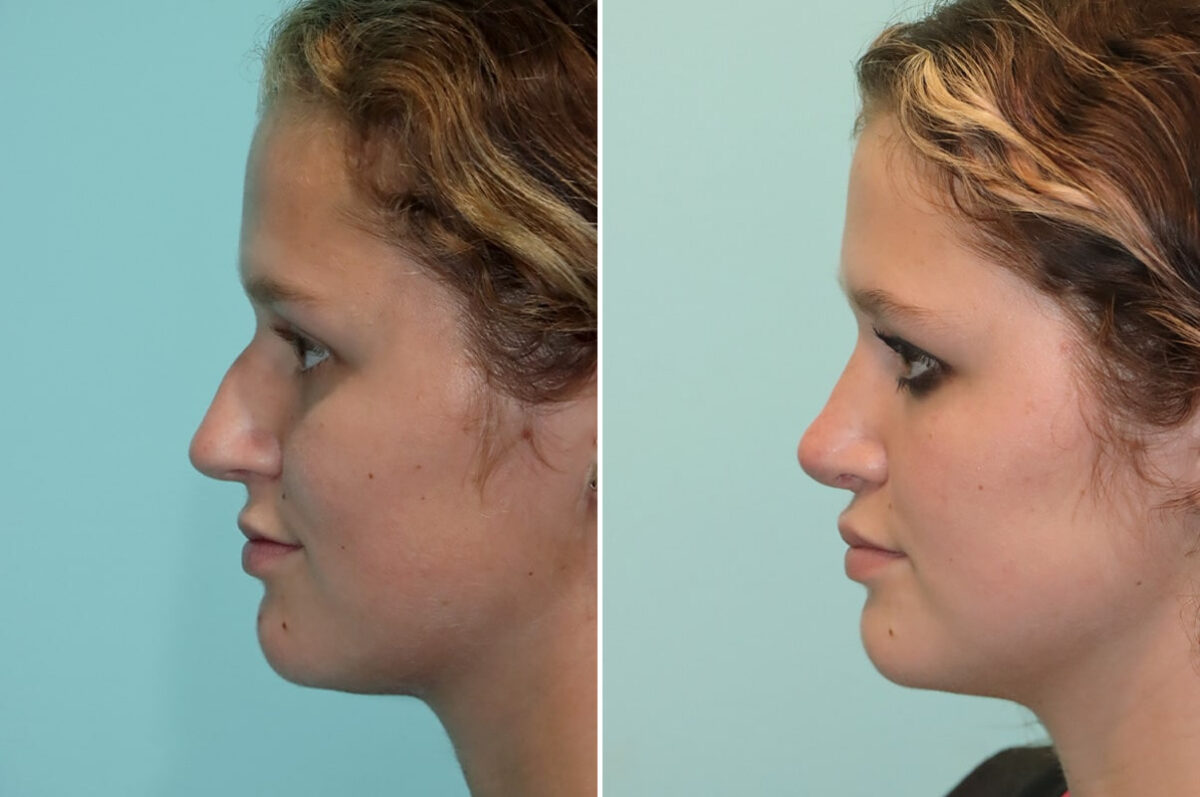 Before and after Rhinoplasty by Dr. Shervin Naderi, Patient 25553