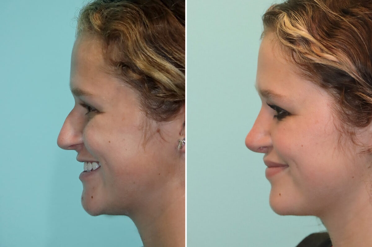 Before and after Rhinoplasty by Dr. Shervin Naderi, Patient 25553