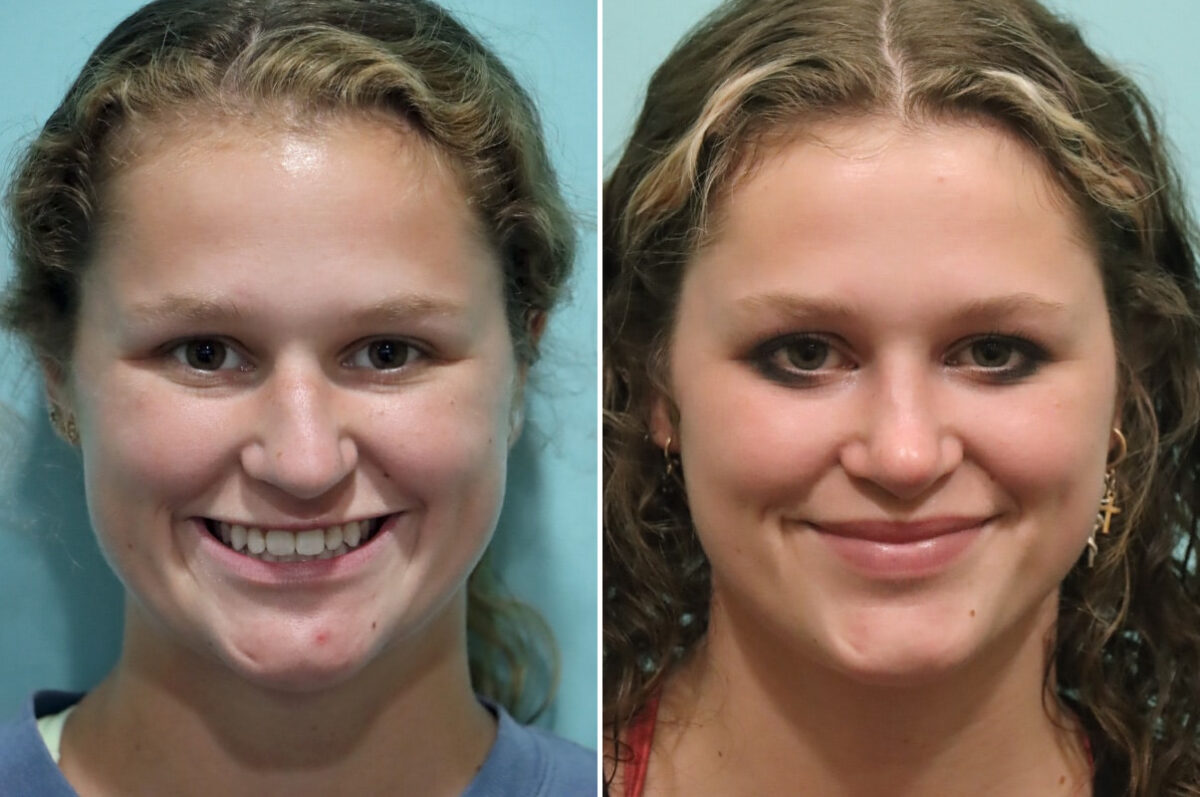 Before and after Rhinoplasty by Dr. Shervin Naderi, Patient 25553