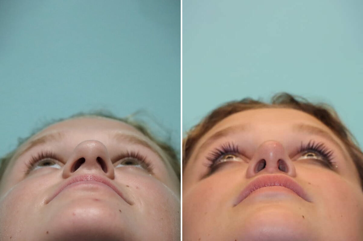 Before and after Rhinoplasty by Dr. Shervin Naderi, Patient 25553