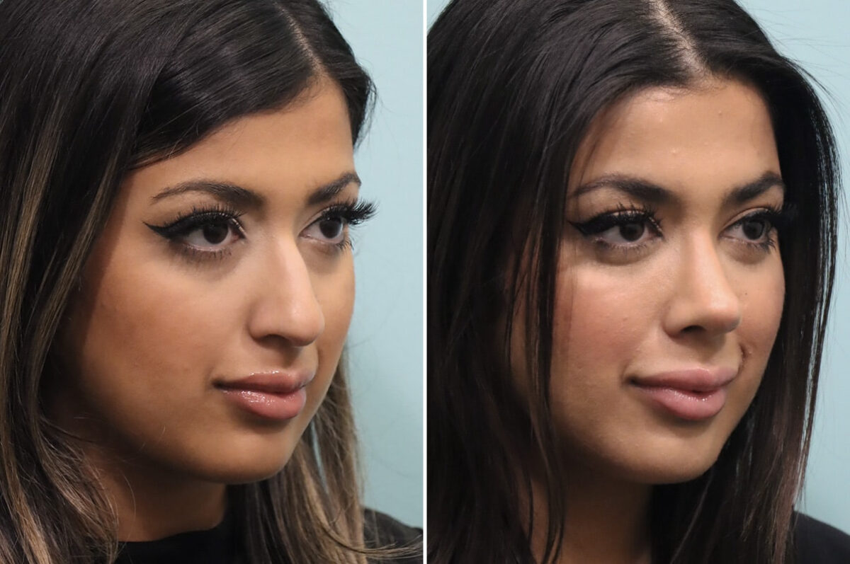 Before and after Rhinoplasty by Dr. Shervin Naderi, Patient 25576