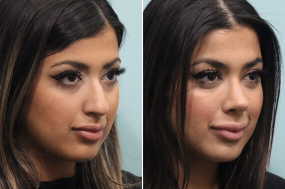 Before and after Rhinoplasty by Dr. Shervin Naderi, Patient 25576