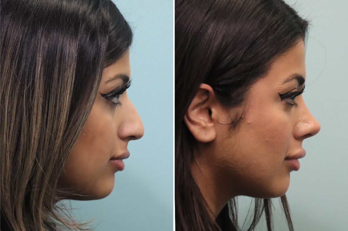 Before and after Rhinoplasty by Dr. Shervin Naderi, Patient 25576