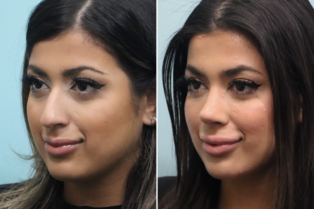 Before and after Rhinoplasty by Dr. Shervin Naderi, Patient 25576