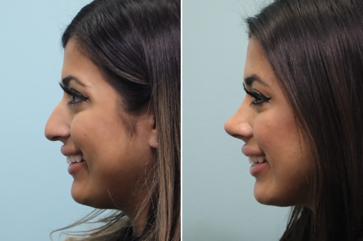 Before and after Rhinoplasty by Dr. Shervin Naderi, Patient 25576