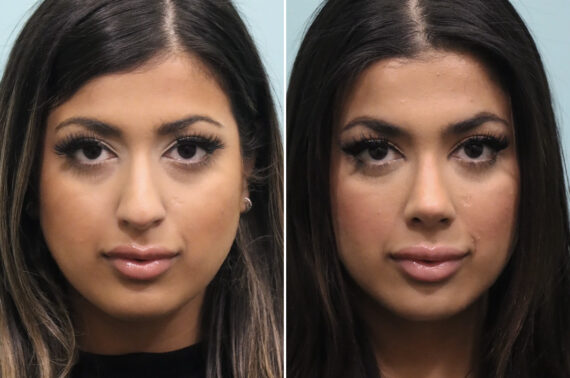 Before and after Rhinoplasty by Dr. Shervin Naderi, Patient 25576