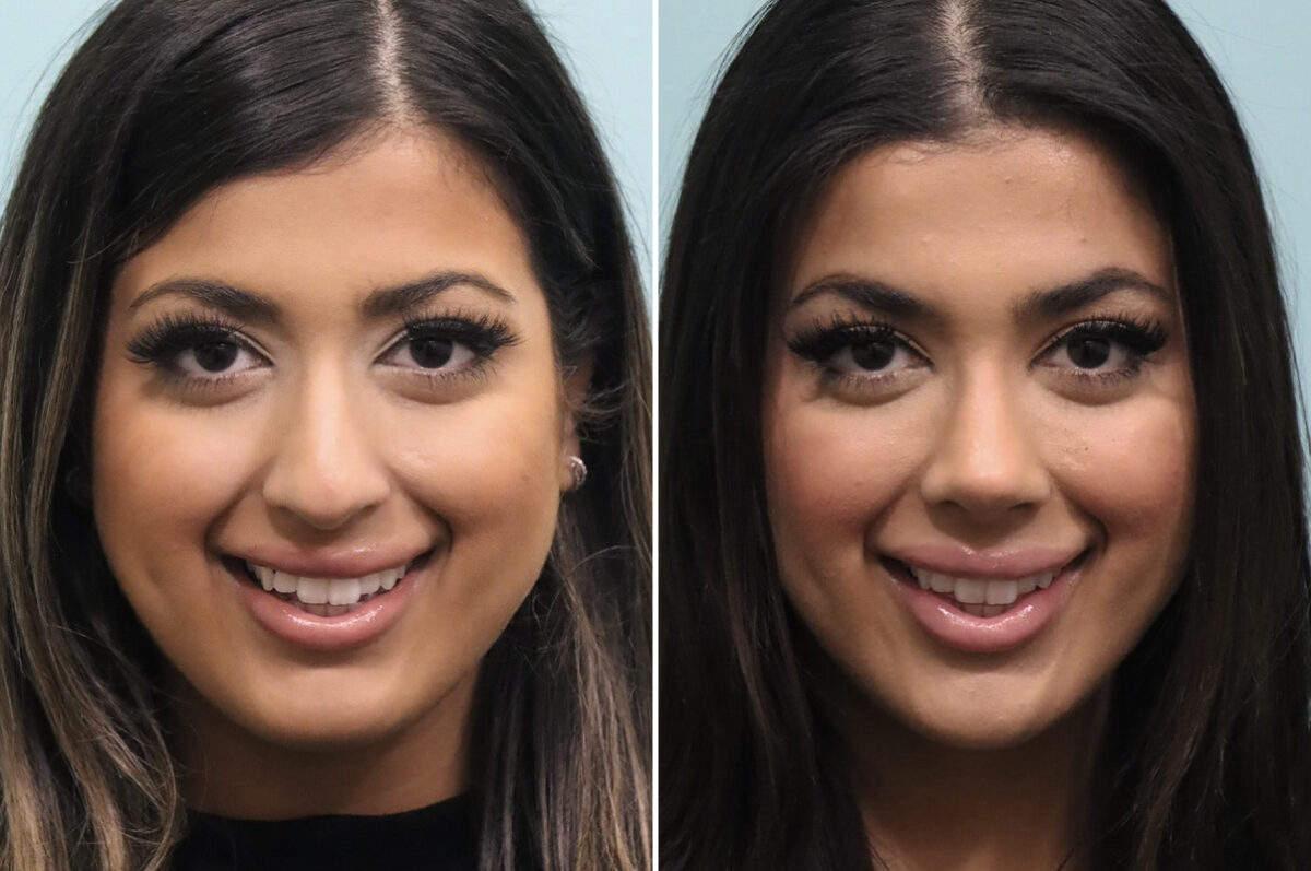 Before and after Rhinoplasty by Dr. Shervin Naderi, Patient 25576