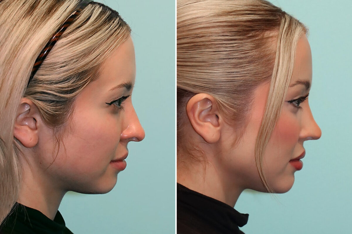 Before and after Rhinoplasty by Dr. Shervin Naderi, Patient 25610