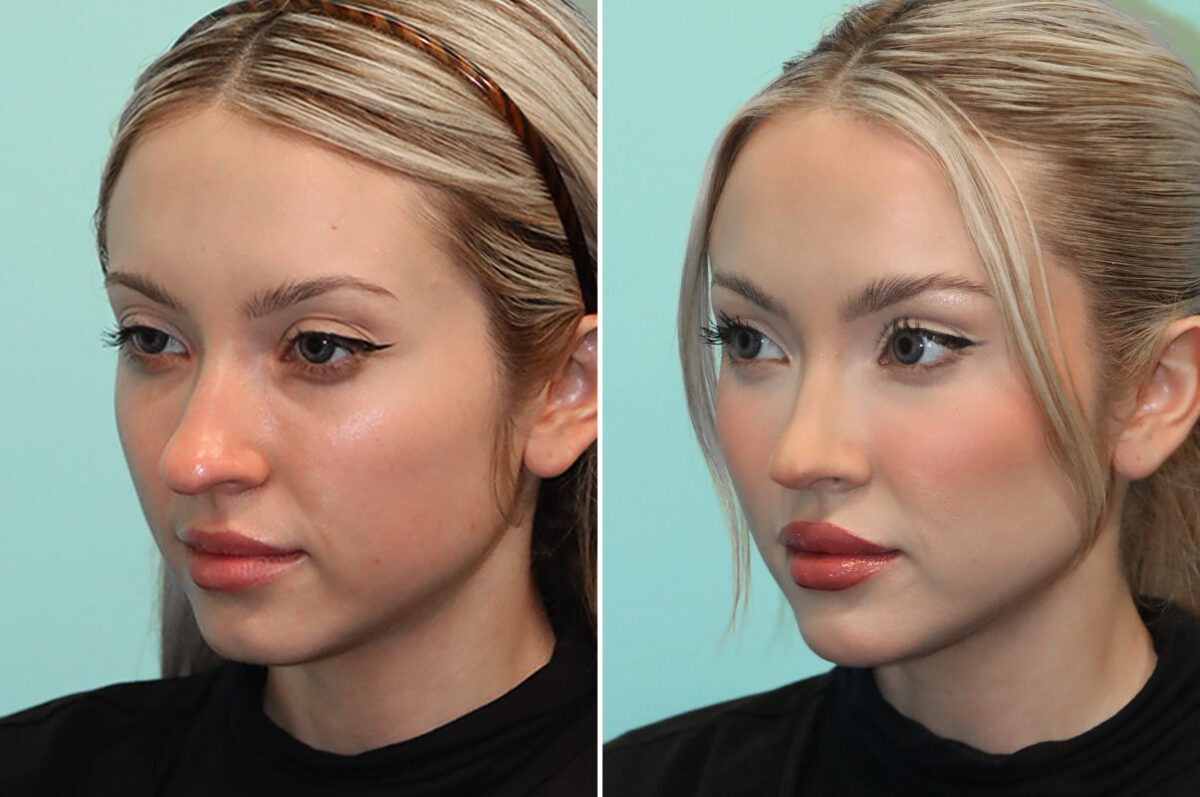 Before and after Rhinoplasty by Dr. Shervin Naderi, Patient 25610