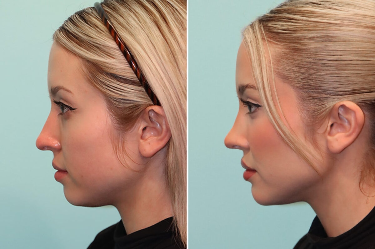 Before and after Rhinoplasty by Dr. Shervin Naderi, Patient 25610
