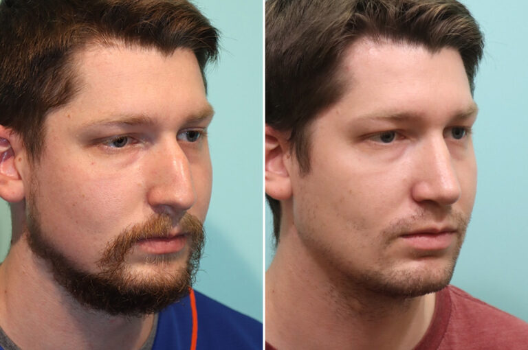 Before and after rhinoplasty by Dr. Shervin Naderi: dorsal hump in a male patient
