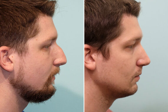 Before and after Rhinoplasty by Dr. Shervin Naderi, Patient 25617
