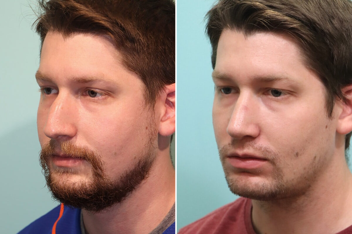 Before and after Rhinoplasty by Dr. Shervin Naderi, Patient 25617