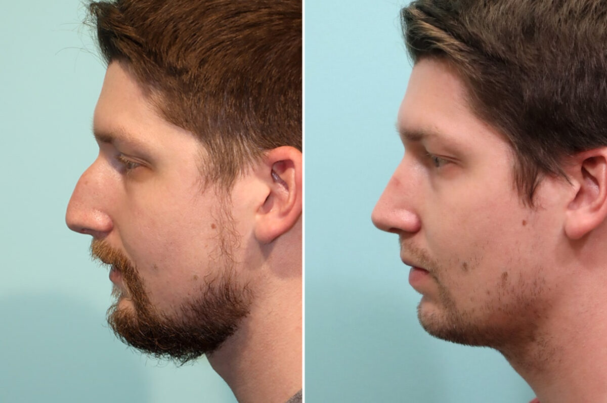 Before and after Rhinoplasty by Dr. Shervin Naderi, Patient 25617