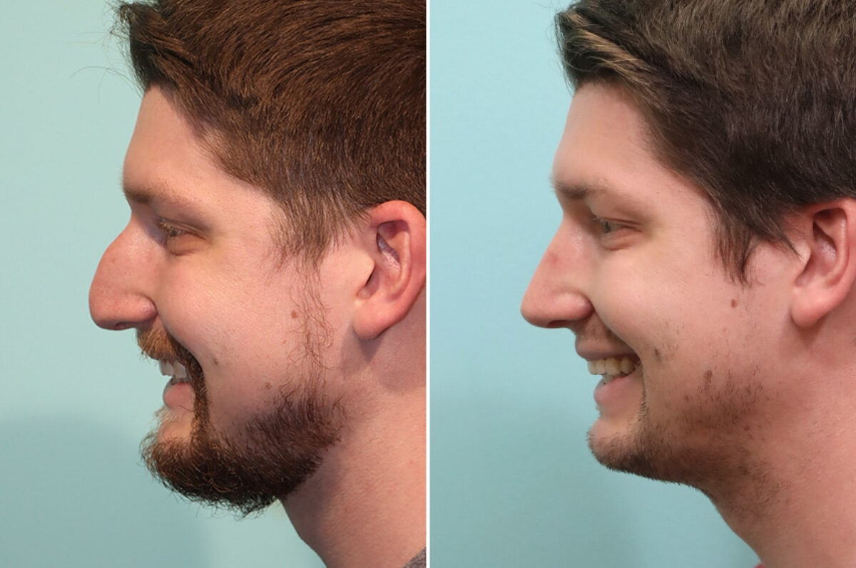 Before and after Rhinoplasty by Dr. Shervin Naderi, Patient 25617