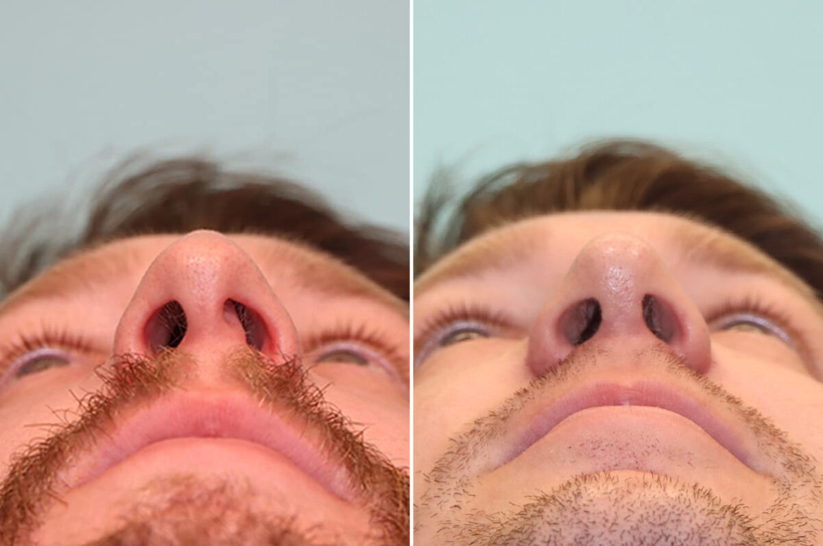 Before and after Rhinoplasty by Dr. Shervin Naderi, Patient 25617