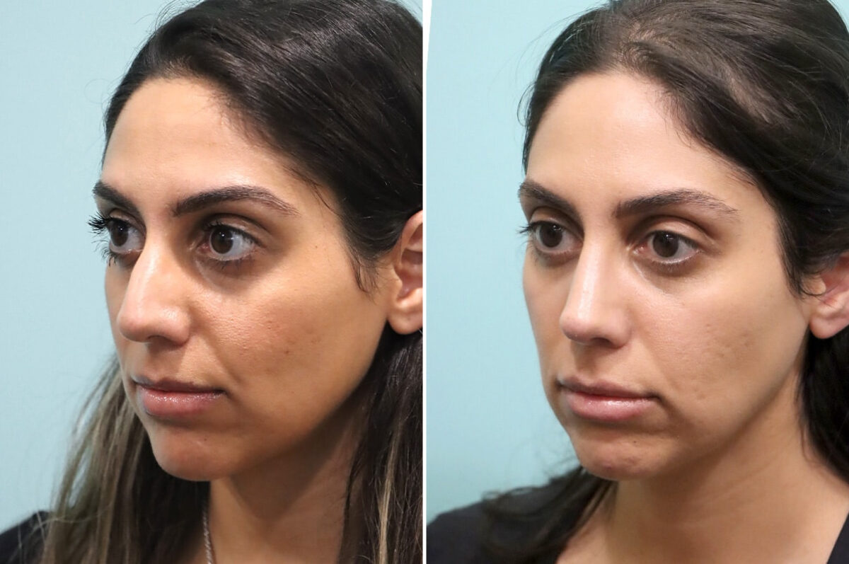 Before and after Rhinoplasty by Dr. Shervin Naderi, Patient 25669