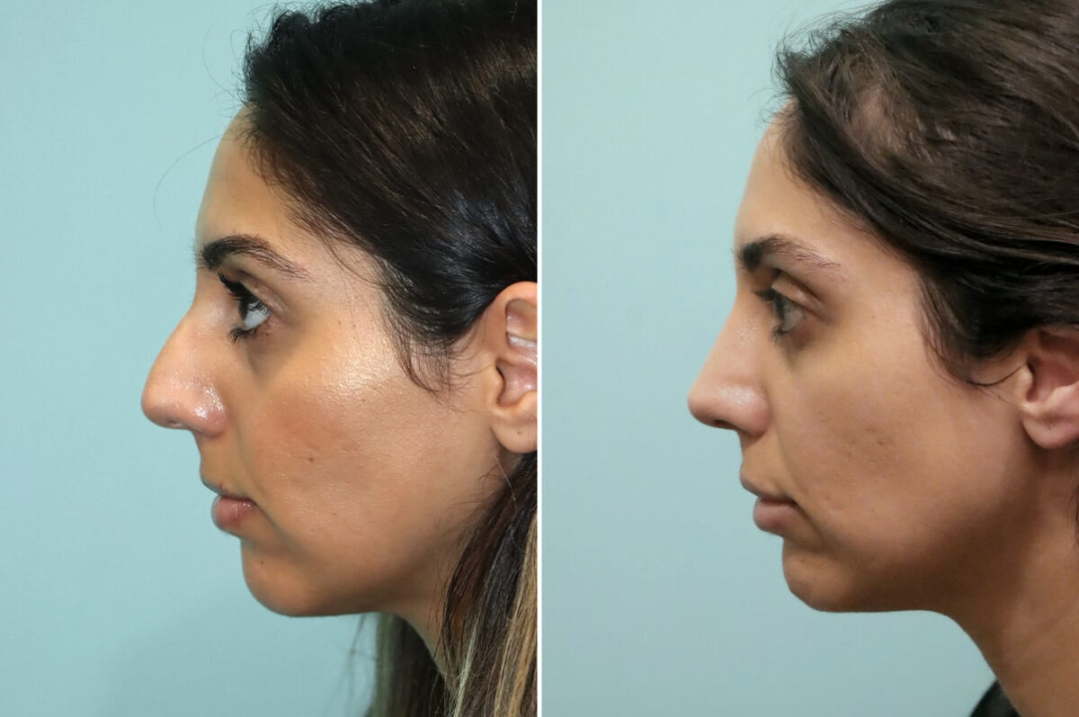 Before and after Rhinoplasty by Dr. Shervin Naderi, Patient 25669
