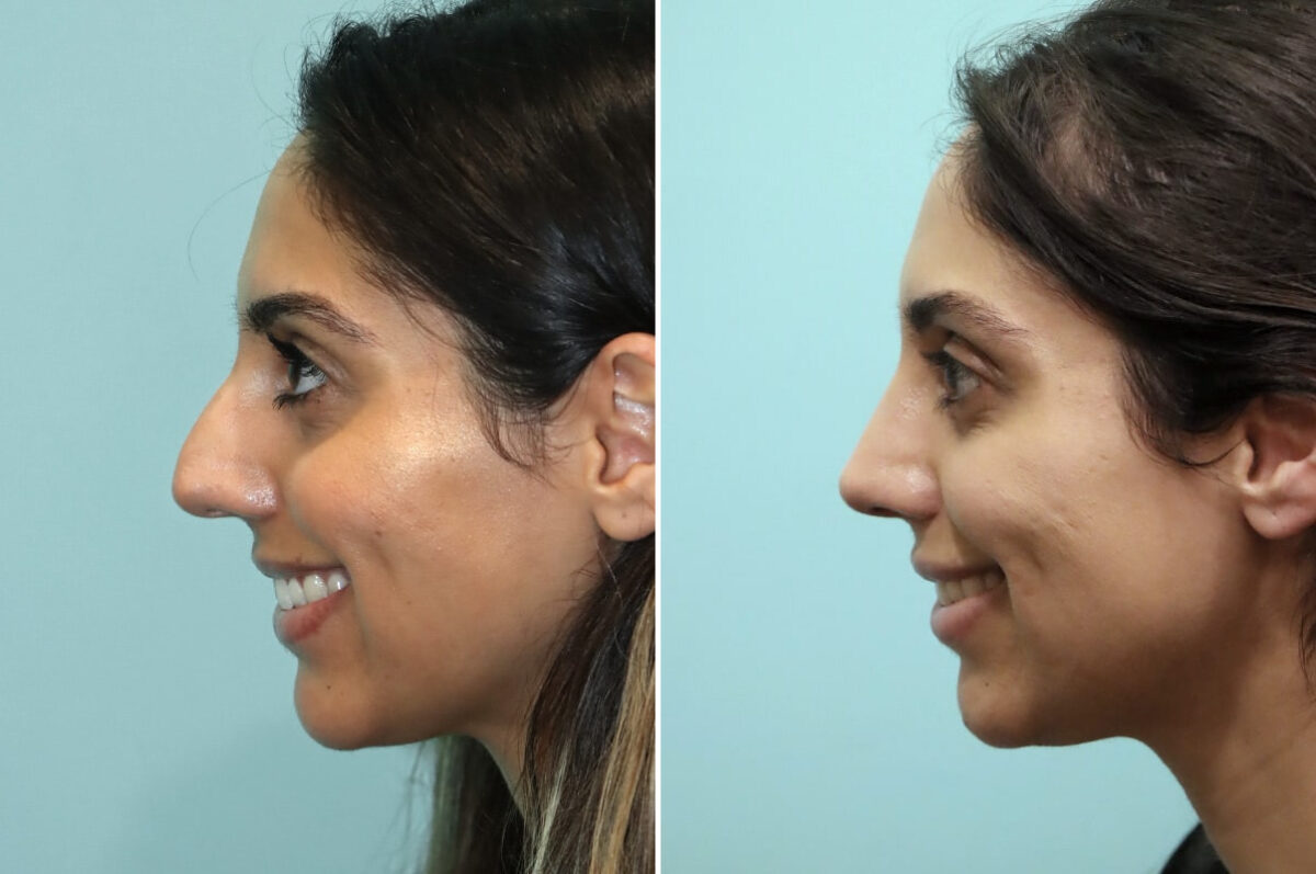 Before and after Rhinoplasty by Dr. Shervin Naderi, Patient 25669