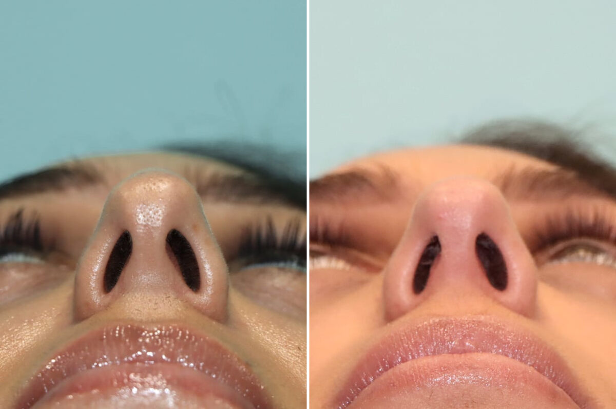 Before and after Rhinoplasty by Dr. Shervin Naderi, Patient 25669