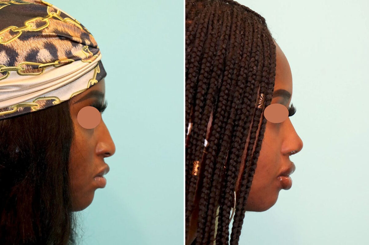 Before and after Rhinoplasty by Dr. Shervin Naderi, Patient 25813